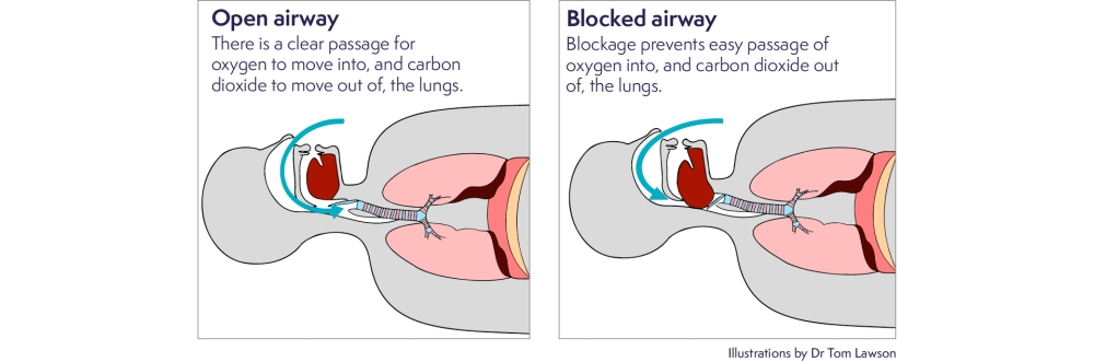 Open and blocked Airway