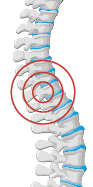 Infection in or around the spine