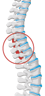 Blood clot around the spine (vertebral haematoma)